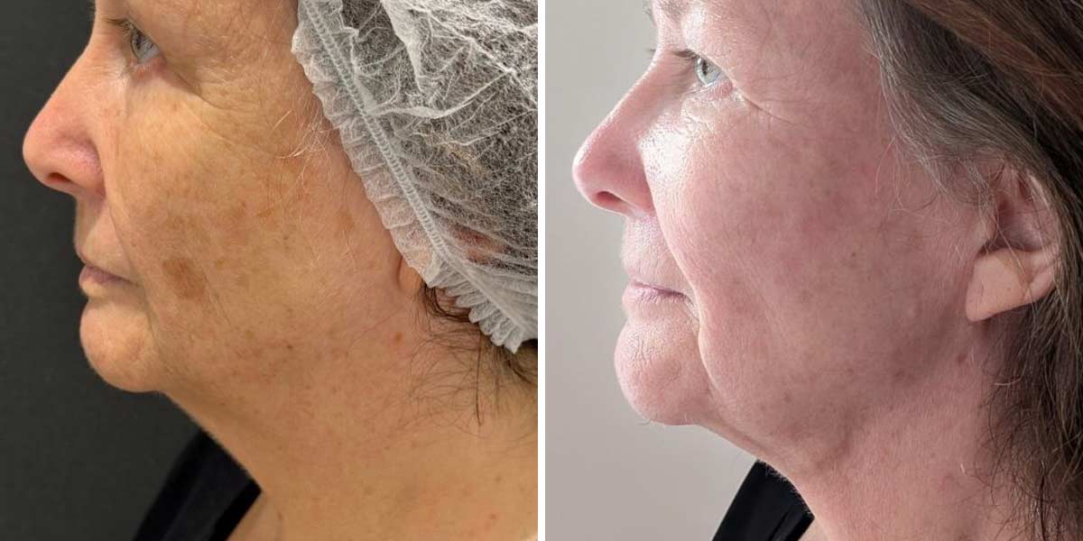 before-after-01