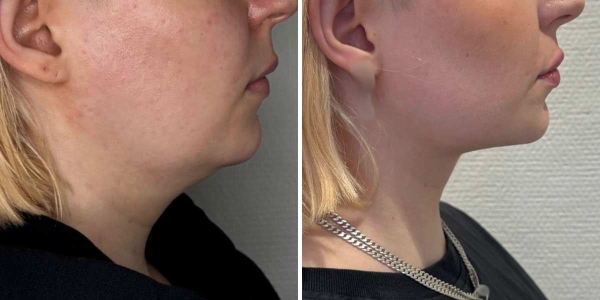 before-after-02