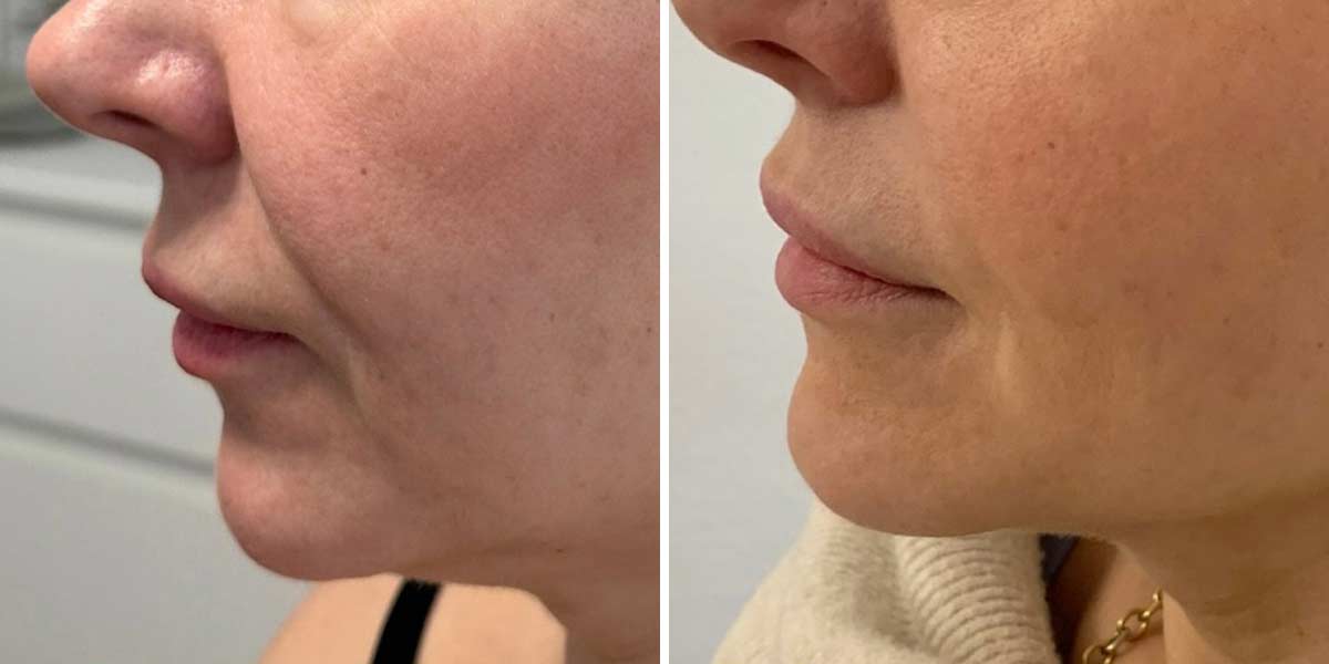 before-after-04